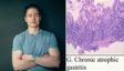 Bryan Johnson Says His "Stomach Is Eating Itself" — Here's What Autoimmune Gastritis Is