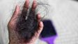 Is It Monsoon Hair Fall Or Something More Serious? How To Tell
