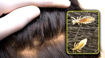 Lice in Hair: মাথায় উকুন বাসা বেঁধেছে? ঘরোয়া উপায়েই রেহাই মিলবে এই সমস্যা থেকে!