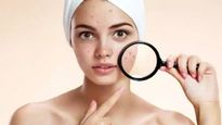 ব্রণের কালো দাগ কিছুতেই যাচ্ছে না? ঘরোয়া উপায়ে দূর হবে সমস্যা!