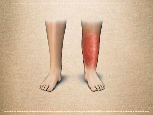 Cellulitis Cellulitis