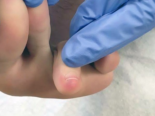 Foot Sores May Be A New Symptom Of Coronavirus