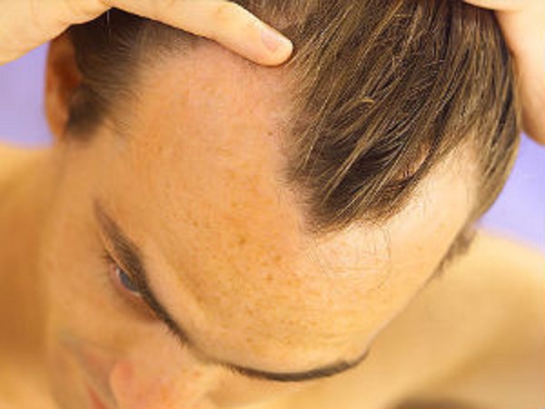 DIY Home Remedies For Baldness