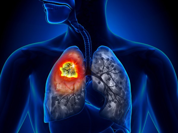 lung cancer symptoms