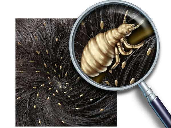 home remedies for lice home remedies for lice