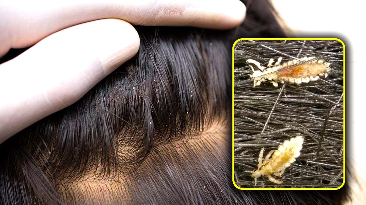 home remedies for lice home remedies for lice