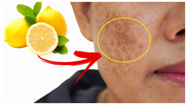 Home Remedies To Remove Dark Spots On Face With Lemon Juice