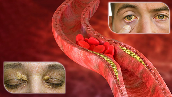 high cholesterol symptoms eyes