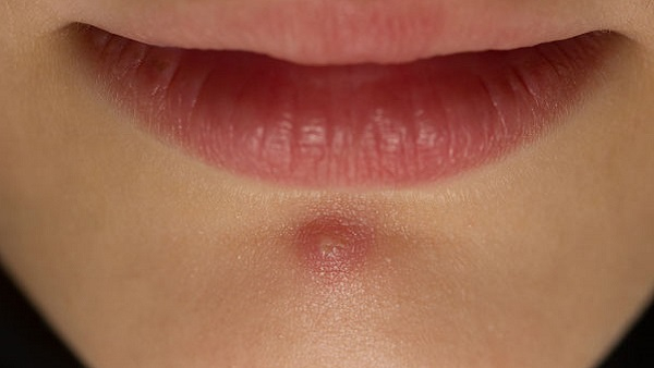 natural remedies for chin acne