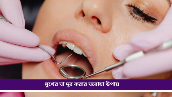 Mouth Ulcer Mouth Ulcer