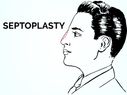 Everything You Need To Know About Septoplasty