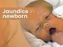 Jaundice In Newborns: Causes, Symptoms, Risk Factors, Diagnosis And Treatment 