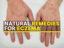 8 Effective Natural Remedies That Can Help Manage Eczema Symptoms