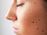 মুখে একাধিক তিল নিয়ে সমস্যায় পড়েছেন? দেখুন অতিরিক্ত তিল দূর করার ঘরোয়া উপায়