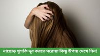 গরমেও খুশকির সমস্যায় দিশেহারা? স্ক্যাল্প ভাল রাখতে মেনে চলুন এই নিয়মগুলি