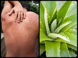 सनबर्न स्किन का ऐसे करें एलो वेरा से ट्रीटमेंट