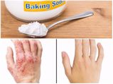 एक्जिमा से राहत पाने के लिए बेकिंग सोडा ऐसे करें यूज
