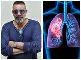 संजय दत्त को हुआ स्‍टेज -3 लंग कैंसर, जानें इस कैंसर के बारे में