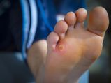 Diabetic Feet : जानें क्‍या होता है डायब‍िटीक फुट, जिसमें से अंगुल‍िया टूटने का भी रहता है डर