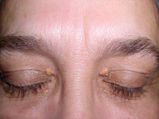 Xanthelasma: कैसे आंखों के आसपास जम जाता है कॉलेस्‍ट्रॉल, जानें लक्षण, वजह और इलाज