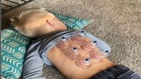 बच्चों में अस्थमा और माइग्रेन की समस्या में Cupping Therapy है फायदेमंद, जानिए इसके अन्य बेनिफिट्स