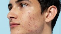 Skincare Tips For Men: पुरुषों की स्किन से पिंपल हटाने के लिए ट्राई करें ये टिप्स