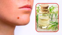 चेहरे पर मौजूद मस्से नहीं लगते अच्छे, तो इस्तेमाल करें टी ट्री ऑयल