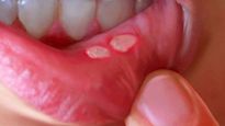 Mouth Ulcers : गर्मी की वजह से मुंह में न‍िकलने लगे छाले, ये उपाय दिलाएंगे ठंडक भरी राहत