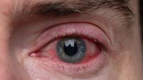 Pink Eye और Conjunctivitis एक ही है या दोनों में होता है अंतर, जानें यहां डिटेल में