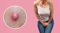Vaginal Boils: बहुत दर्दनाक होते हैं प्राइवेट पार्ट पर हुए फोड़े, लेडीज जान लें वज‍ह और इलाज