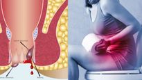 Bleeding Piles: अगर आप भी खूनी बवासीर से परेशान हैं, तुरंत आजमाइए ये सरल और घरेलू नुस्‍खें