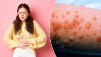 पेनक‍िलर खाने से महिला के शरीर में बन गए फफोले और कोमा में चली गई, क्‍या है SJS बीमारी?