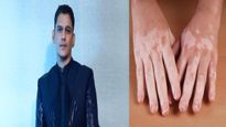 Mirzapur Actor Vijay Varma को है विटिलिगो स्किन प्रॉब्लम, जानें क्या है इसके लक्षण और कैसे होता है इसका उपचार