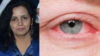 बार‍िश में बढ़ जाता है Pink Eye का खतरा , आई स्‍पेशल‍िस्‍ट से जानें इससे बचने का तरीका