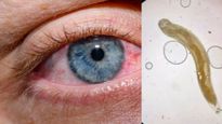 भोपाल में दुर्लभ मामला, पहली बार मरीज की आंख से निकाला 1 इंच लंबा कीड़ा, नॉनवेज खाने वाले रहें अलर्ट!