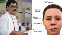 क्‍या है Bell’s Palsy Disease ज‍िसके श‍िकार हुए महाराष्ट्र के मंत्री धनंजय मुंडे, क‍ितनी खतरनाक है ये बीमारी