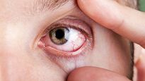 Heatwave में बढ़ जाता है Eye Stroke का खतरा, इन गलतियों से बचें, जानें एक्सपर्ट की सलाह