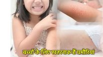 Home Remedies For Prickly Heat: घमौरियों से बच्चे हो गए हैं परेशान, आजमाएं ये 5 असरदार घरेलू उपाय