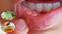 Home Remedies For Mouth Ulcers: मुंह के छालों से हो गए हैं परेशान, तो आजमाएं ये 10 असरदार घरेलू इलाज