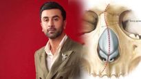 रणबीर कपूर को है Nasal Septum नाम की खतरनाक बीमारी ? जानें इसके कारण, लक्षण और बचाव के तरीके