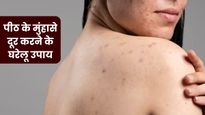 पीठ के मुंहासे दूर करने के लिए आजमाएं ये 5 घरेलू उपाय, बिना दर्द के मिलेगा छुटकारा