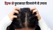 सर्दियों में डैंड्रफ से हैं परेशान तो नारियल तेल में मिलाकर लगाएं ये 2 चीजें, छूमंतर हो जाएगी रूसी
