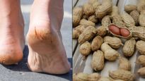 Cracked Heels Remedy: मूंगफली के छिलकों से बनाएं होममेड फुट मास्क, एड़ियां बनेंगी मखमल जैसी सॉफ्ट