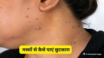 त्वचा पर अचानक क्यों निकलने लगते हैं भद्दे मस्से? जानें इन्हें गायब करने के 5 घरेलू उपचार