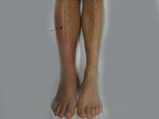 Deep Vein Thrombosis During Pregnancy