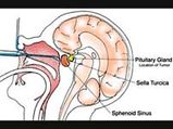 Pituitary Tumour Symptoms And Treatment