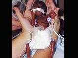 Smallest Baby In India â€“ Against All Odds!