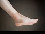 Why Do You Get Swollen Feet?