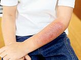 Heal Your Burn Scars Quick 