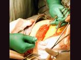 Synthetic Sutures Proven Best Post Delivery